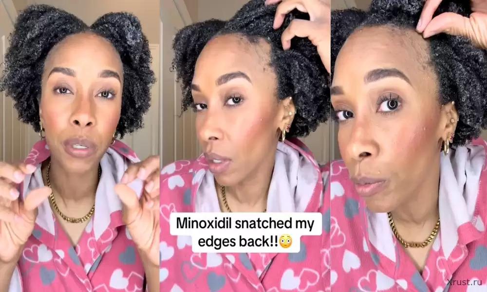 A woman tried a hair growth product and ended up with bald patches