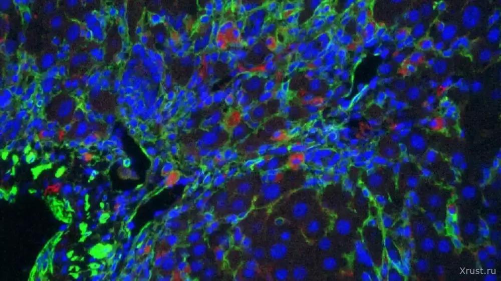 Brain cancer is successfully treated with CAR-T cells, Gilead announces